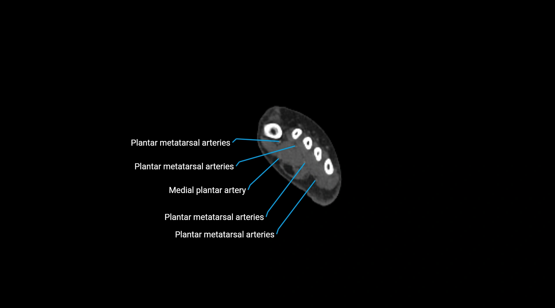 CTA lower limb cross sectional anatomy labelled image _299.webp